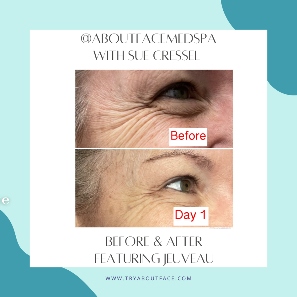 About Face medspa & wellness before & after crow's feet