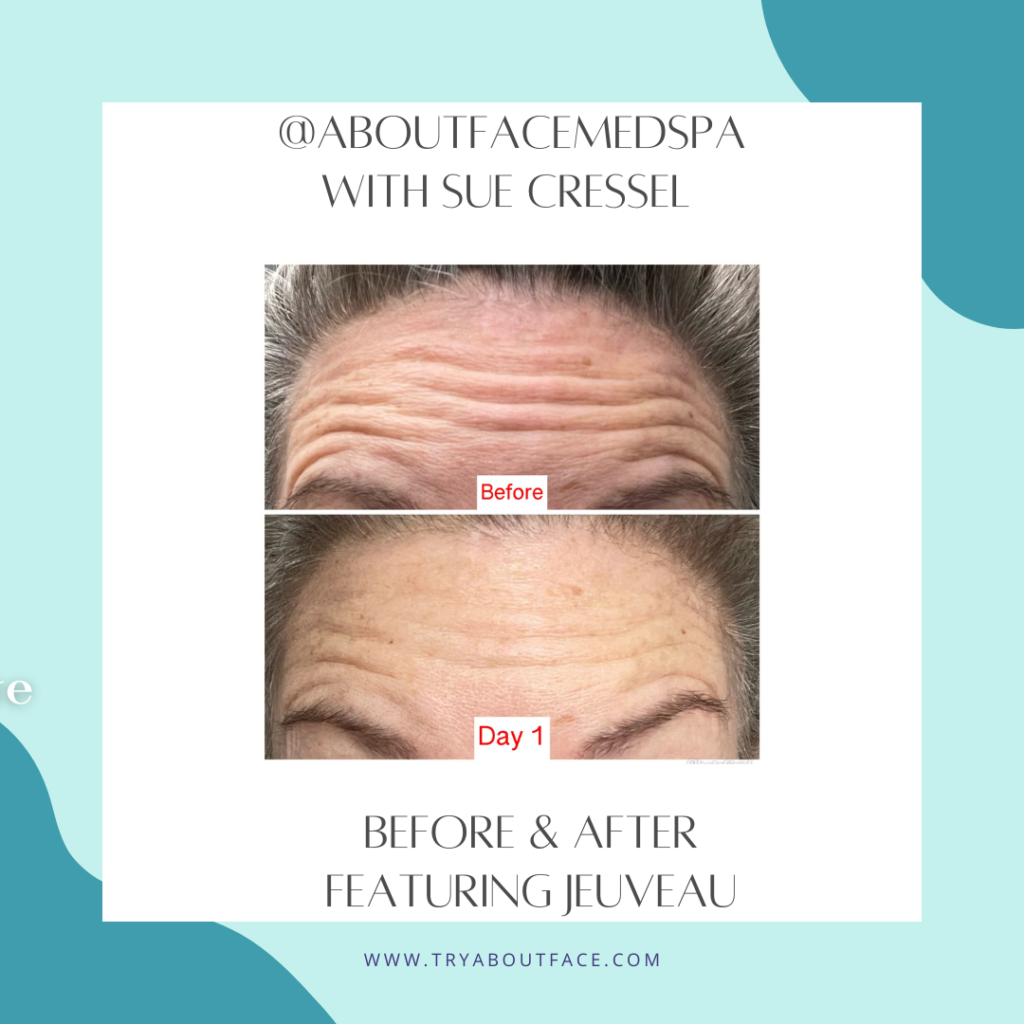 About Face medspa & Wellness Before and After Jeuveau Forehead