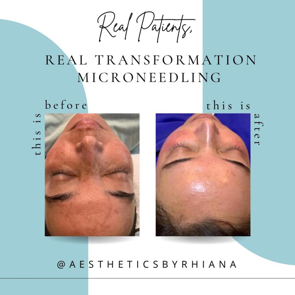 Microneedling Before & After by Rhiana DeGennaro