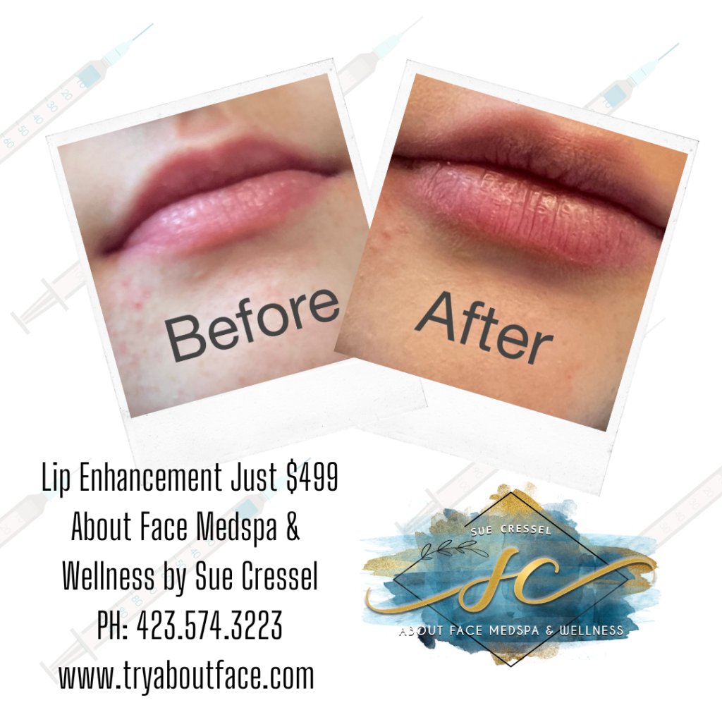 Lip Enhancement by Sue Cressel About Face Medspa & Wellness $499 During January