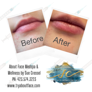 Lip enhancement by sue Cressel of about face medspa & wellness