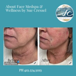 Silhouette Lift Before and After by Sue Cressel, About Face Medspa & Wellness