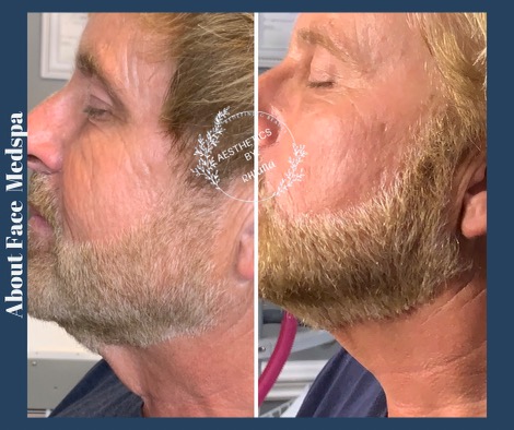 Morpheus8 RF frequency before and after from About Face Medspa & Wellness