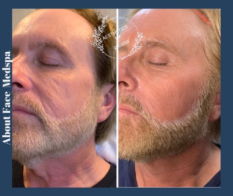 Morpheus8 RF frequency before and after from About Face Medspa & Wellness