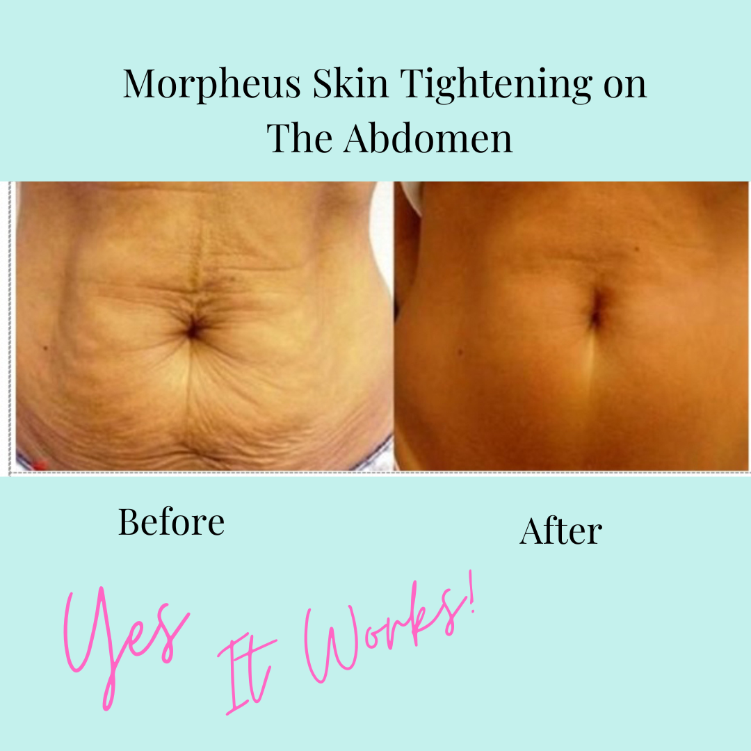 Morpheus Skin Tightening on Abdomen Before & After
