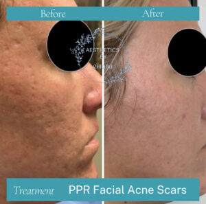 Acne Scars Respond to PRP Treatment