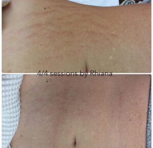 PRP treatment results for stretch marks.