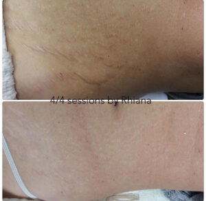 PRP Stomach Treatment for Stretch Marks