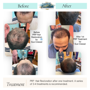 PRP Hair Restoration Before & After By Sue Cressel