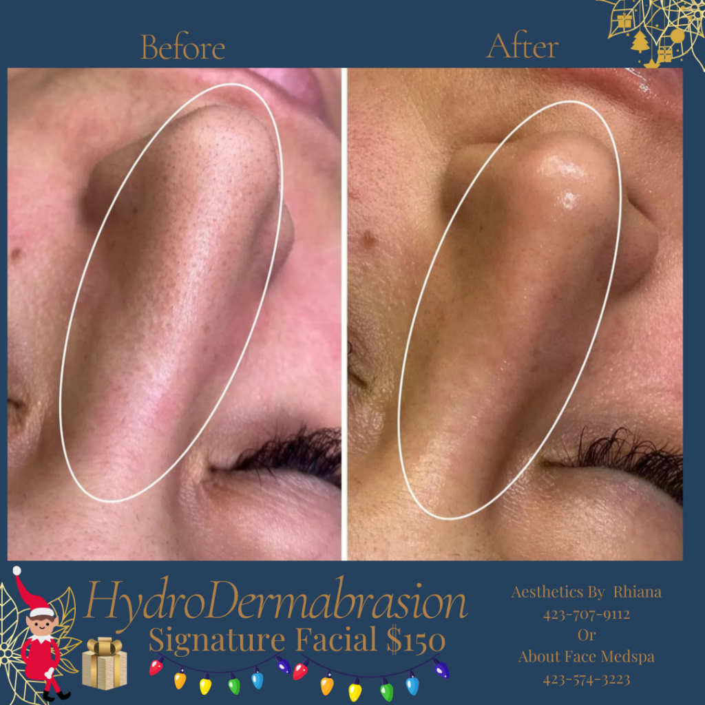 HydroDermabrasion Facial Treatment to Nose Area