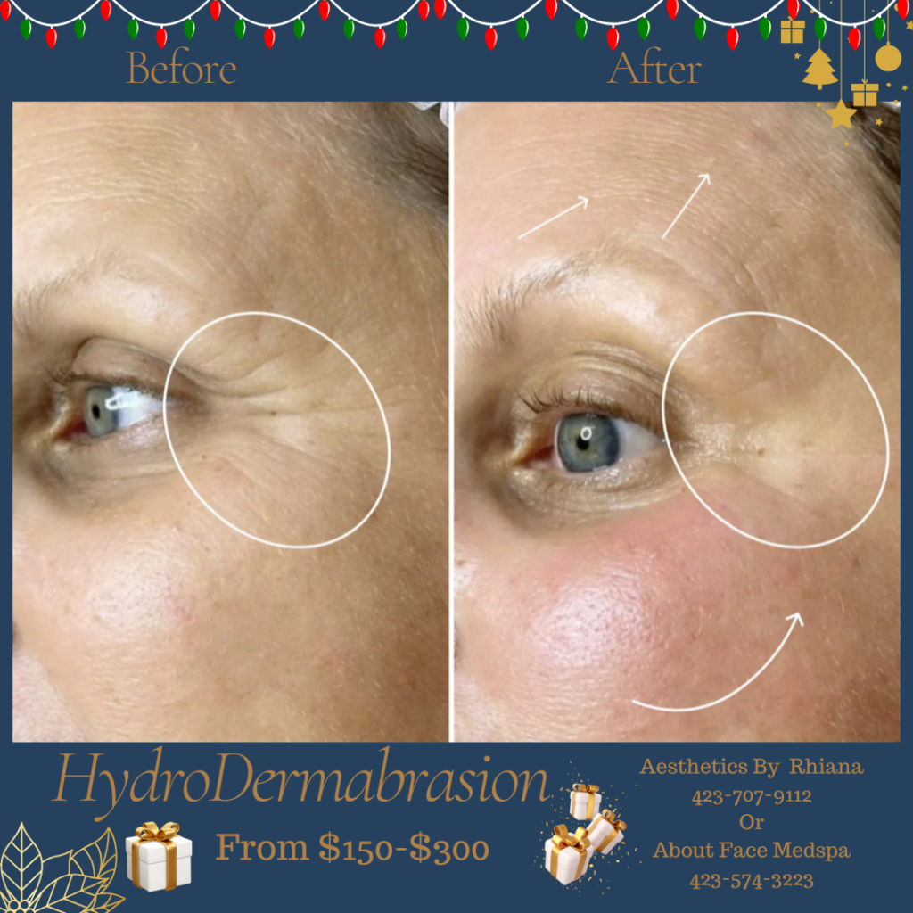 HydroDermabrasion Facial Treatment to Eye/Orbital Area