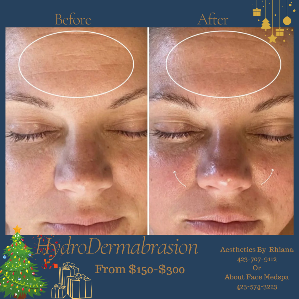 HydroDermabrasion Facial Treatment to Forehead Area