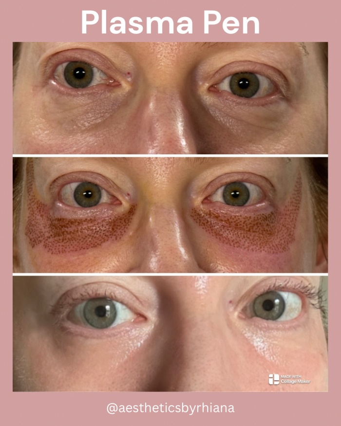 Plasma Pen Fibroblast Therapy Before & After Plasma Pen Fibroblast Therapy Before & After