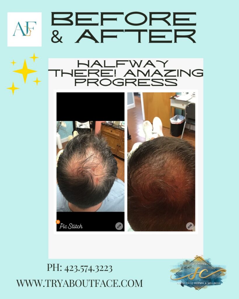 PRP Hair Restoration Therapy Before & After PRP Hair Restoration Therapy Before and After